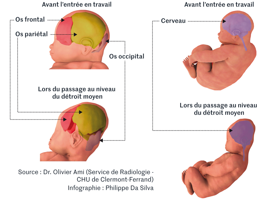 Modélisation de la déformation des os du crâne (à gauche) et du cerveau (à droite) du bébé au moment de l'accouchement.