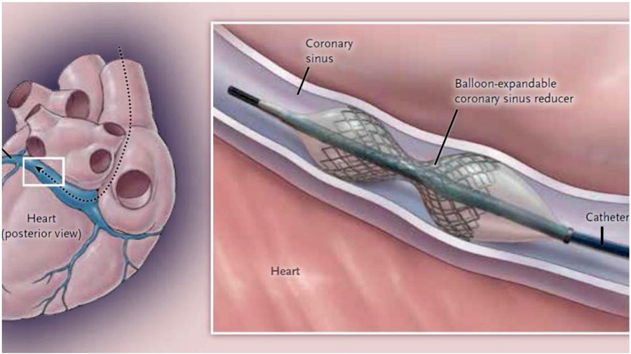 Le réducteur de sinus offre en retour une redistribution de la vascularisation cardiaque améliorant la symptomatologie dans 71% des cas. (CHU Brest)