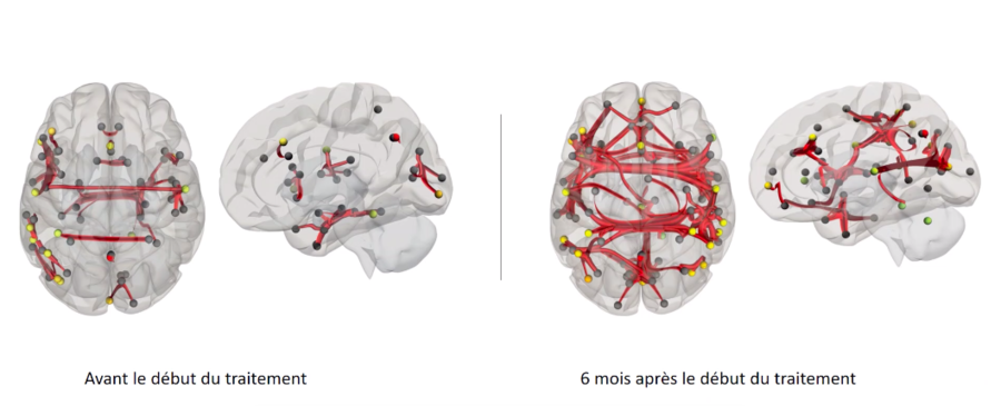 L'imagerie cérébrale atteste d'augmentation des connexion neuronales. (Inserm)