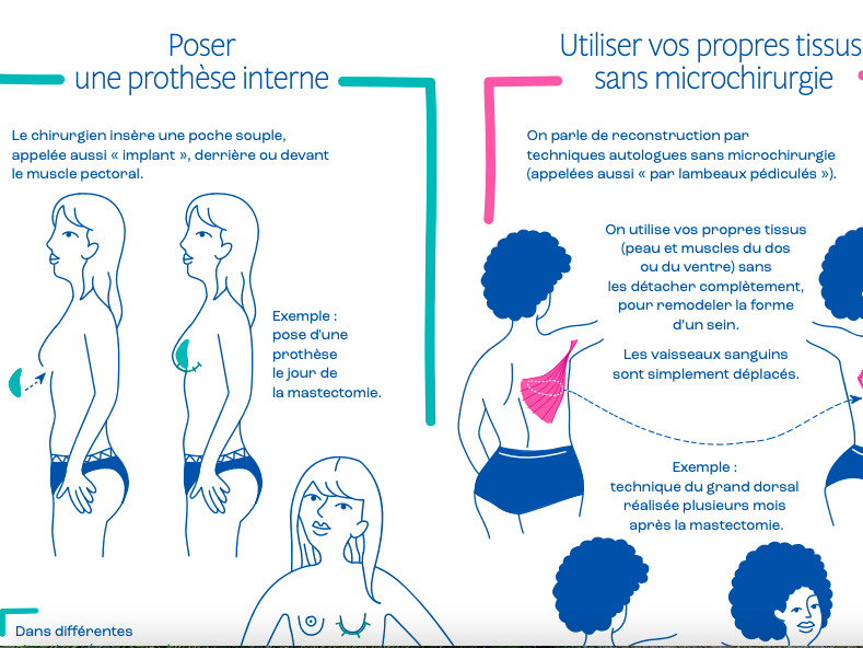 Sur la plateforme, les patientes ont accès à une infographie simplifiée sur les principales catégories de techniques de reconstruction. (Infographie HAS et Inca)